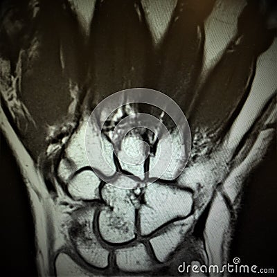 Mri fracture bones wrist exam Stock Photo