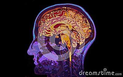 MRI Image Of Head Showing Brain Stock Photo