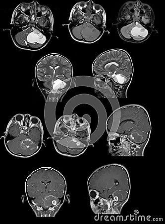 MRI image show a tumour in cerebellum Stock Photo