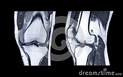 MRI Knee joint or Magnetic resonance imaging compare coronal and sagittal view . Stock Photo