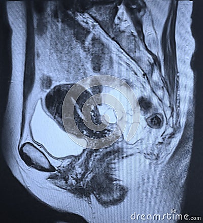 Mri large ovarian cysts radiological exam Stock Photo