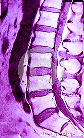 MRI of lumbar spine Stock Photo