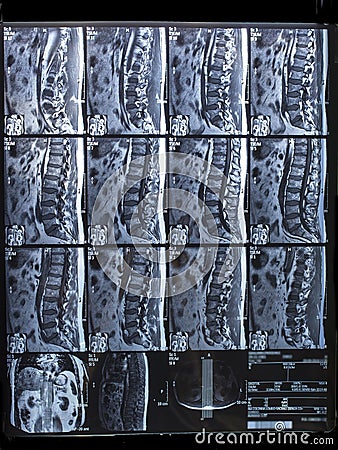 MRI lumbosacral column, hernia intra-foraminal right L5-S1 Stock Photo