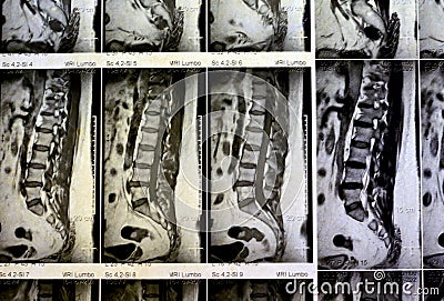 MRI lumbosacral spine without contrast revealed back muscle spasm, Mild L3-L4, L4-L5 disc lesions, Sacral, L5 and T12 vertebral Stock Photo