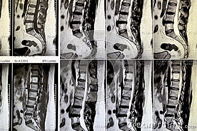 MRI lumbosacral spine without contrast revealed back muscle spasm, Mild L3-L4, L4-L5 disc lesions, Sacral, L5 and T12 vertebral Stock Photo