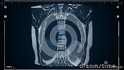 Mri Lung Scan, Magnetic Resonance Imaging of a Back and Skeleton Close-up.  Diagnosis of Viral or Covid-19 Respiratory Stock Video - Video of  electronic, analysis: 219762939