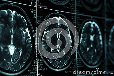 MRI or magnetic resonance image of head and brain scan. Close up view Stock Photo