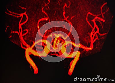 Mri of neck and brain vessels Stock Photo