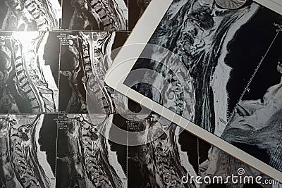 MRI Pictures of spinal column with magnification on overlaying t Stock Photo