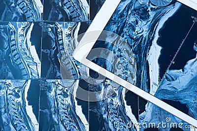 MRI Pictures of spinal column with magnification on overlaying t Stock Photo