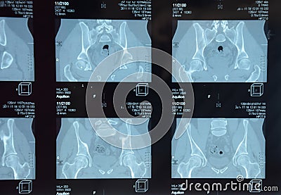 MRI sacroiliac articulation. Study of ankylosing spondyloarthritis patient Stock Photo