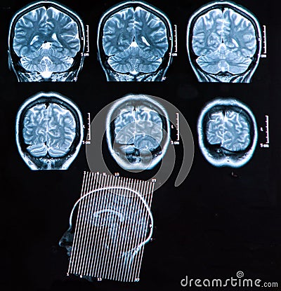 Mri Brain Scan Stock Photo