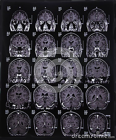 MRI scan image of brain Stock Photo