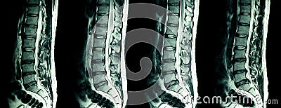 MRI scan of lumbar spines of a patient with chronic back pain Stock Photo