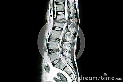 MRI scan of lumbar spines of a patient with kyphosis and back pa Stock Photo