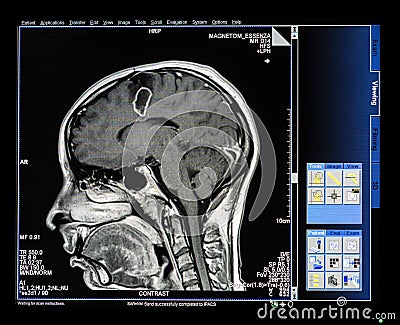 Mri Scan Monitor Stock Photo