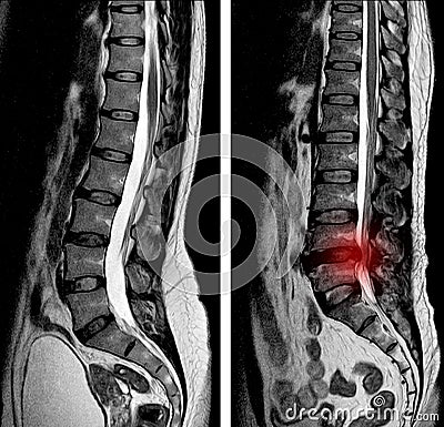 MRI scan sagittal view Lumbosacral spine has straightening lumbar alignment, L5-S1 Stock Photo