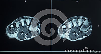 MRI scan test results foot toes injury Stock Photo