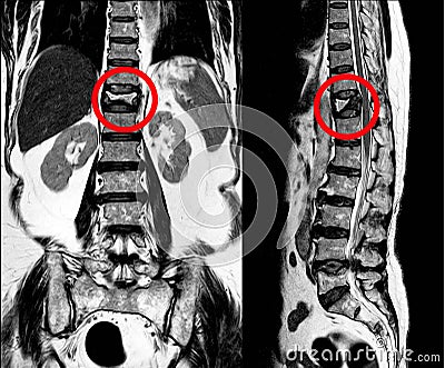 MRI Thoracic lumbar spine show moderate pathological compression fracture of T12 level Stock Photo