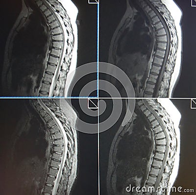 Mri of thoracic spine pathology Stock Photo