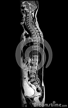 MRI of whole spine T2W sagittal plane Stock Photo