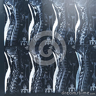 MRI xray film scan of sacro-lumbar spines of a patient with chronic back pain Stock Photo
