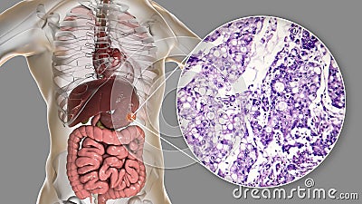 Mucinous adenocarcinoma of stomach, illustration and micrograph Cartoon Illustration