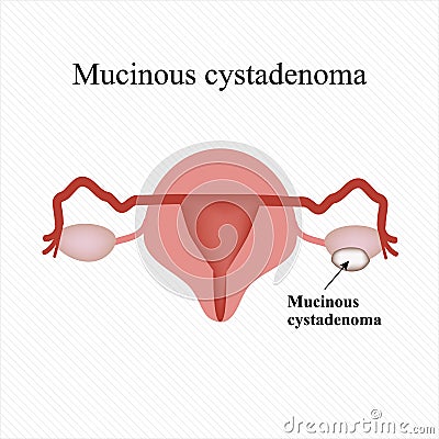 Mucinous cyst on the ovary. Cystadenoma. . Infographics. Vector illustration Vector Illustration