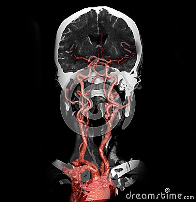 Multi view 2D and 3D Rendering image of CT angiography Stock Photo