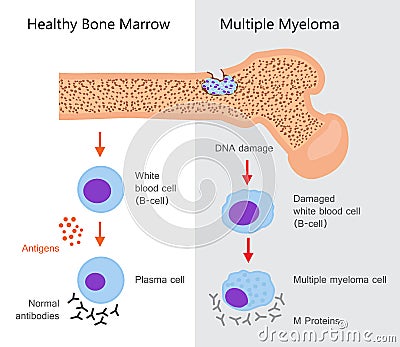 Multiple Myeloma Diagram Vector Illustration