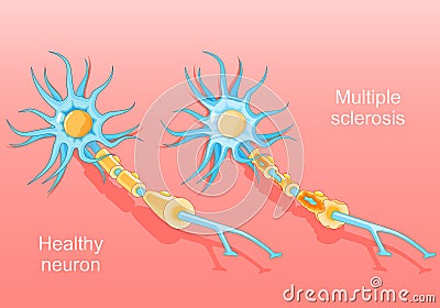 Multiple sclerosis. Autoimmune disease Vector Illustration