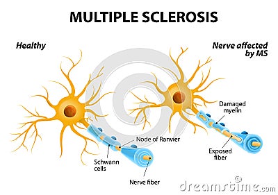 Multiple Sclerosis Vector Illustration