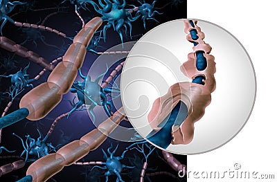 Multiple Sclerosis Myelin Disease Cartoon Illustration