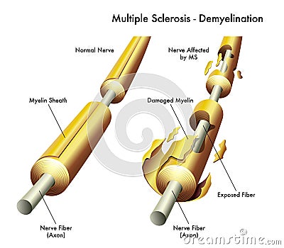 Multiple sclerosis nerve damage Vector Illustration