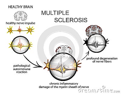 Multiple sclerosis. Neurology Vector Illustration