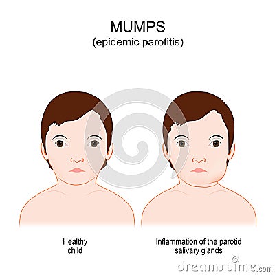 Mumps. Epidemic parotitis. viral disease Vector Illustration