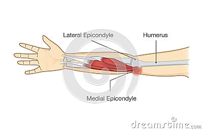 Muscle injury and tear in tendon at elbow area. Vector Illustration