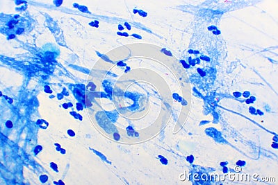 Mycobacterium tuberculosis positive small red rod in sputum smear Stock Photo