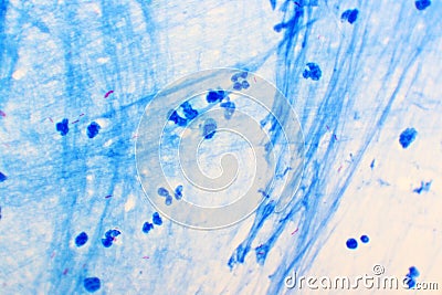 Mycobacterium tuberculosis positive small red rod in sputum smear Stock Photo