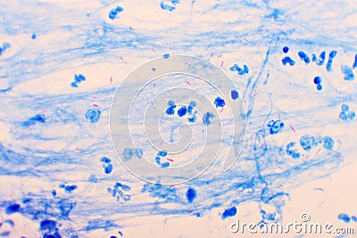 Mycobacterium tuberculosis positive in sputum smear Stock Photo