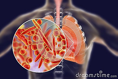 Mycoplasma pneumoniae bacteria in human lungs Cartoon Illustration