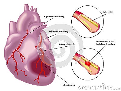 Myocardial infarction Vector Illustration