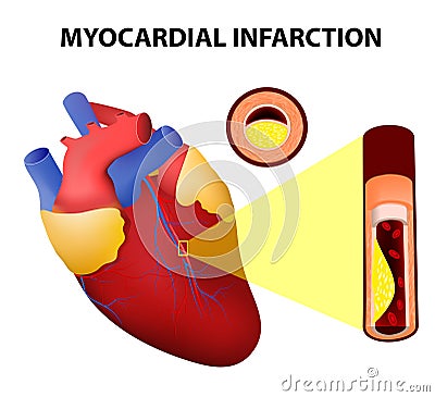 Myocardial infarction Vector Illustration