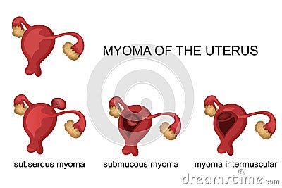 Myoma of the uterus Vector Illustration