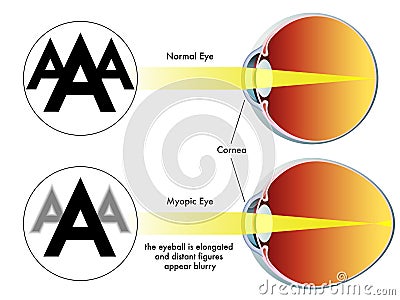Myopia Vector Illustration