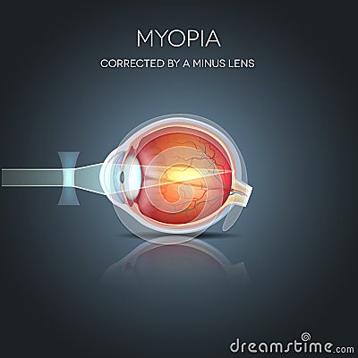 Myopia corrected Vector Illustration