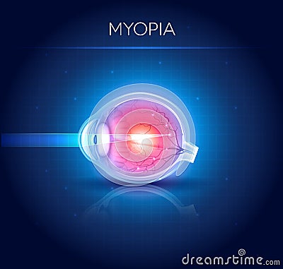 Myopia eyesight disorder Vector Illustration