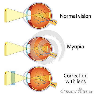 Myopia and myopia corrected by a minus lens. Vector Illustration