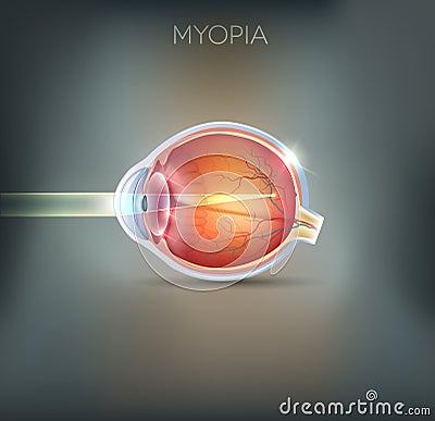 Myopia, vision disorder Vector Illustration