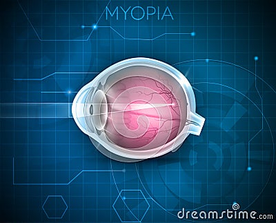 Myopia, vision disorder Vector Illustration